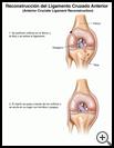 Thumbnail image of: Anterior Cruciate Ligament Reconstruction: Illustration