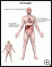 Thumbnail image of: Acromegaly (Excess Growth Hormone): Illustration