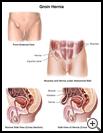 Thumbnail image of: Groin Hernia: Illustration