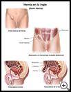 Thumbnail image of: Groin Hernia: Illustration