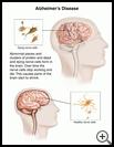 Thumbnail image of: Alzheimer’s Disease: Illustration