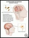 Thumbnail image of: Alzheimer’s Disease: Illustration