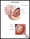 Thumbnail image of: Amniocentesis: Illustration