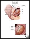 Thumbnail image of: Amniocentesis: Illustration