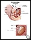 Thumbnail image of: Amniocentesis: Illustration