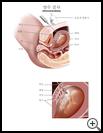 Thumbnail image of: Amniocentesis: Illustration