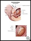 Thumbnail image of: Amniocentesis: Illustration