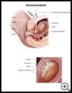 Thumbnail image of: Amniocentesis: Illustration