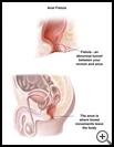 Thumbnail image of: Anal Fistula: Illustration