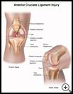 Thumbnail image of: Anterior Cruciate Ligament Injury: Illustration