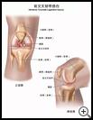 Thumbnail image of: Anterior Cruciate Ligament (ACL) Injury: Illustration