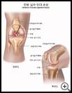 Thumbnail image of: Anterior Cruciate Ligament (ACL) Injury: Illustration