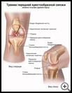 Thumbnail image of: Anterior Cruciate Ligament (ACL) Injury: Illustration