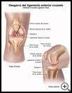 Thumbnail image of: Anterior Cruciate Ligament (ACL) Injury: Illustration