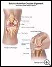 Thumbnail image of: Anterior Cruciate Ligament (ACL) Injury: Illustration