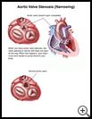 Thumbnail image of: Aortic Valve Stenosis (Narrowing): Illustration