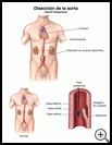 Thumbnail image of: Aortic Dissection: Illustration