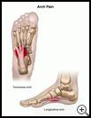 Thumbnail image of: Arch Pain: Illustration