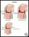 Thumbnail image of: Arthritis: Illustration