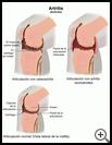 Thumbnail image of: Arthritis: Illustration