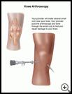 Thumbnail image of: Knee Arthroscopy: Illustration