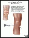 Thumbnail image of: Knee Arthroscopy: Illustration