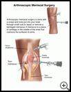 Thumbnail image of: Arthroscopic Meniscal Surgery: Illustration