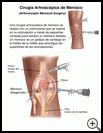 Thumbnail image of: Arthroscopic Meniscal Surgery: Illustration