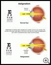 Thumbnail image of: Astigmatism: Illustration