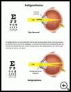 Thumbnail image of: Astigmatism: Illustration