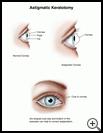 Thumbnail image of: Astigmatic Keratotomy: Illustration