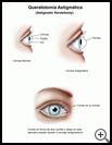 Thumbnail image of: Astigmatic Keratotomy: Illustration