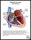 Thumbnail image of: Atrial Fibrillation: Illustration