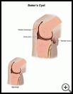 Thumbnail image of: Baker's Cyst: Illustration