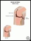 Thumbnail image of: Baker's Cyst: Illustration