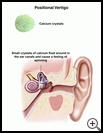 Thumbnail image of: Positional Vertigo: Illustration