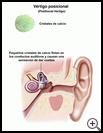 Thumbnail image of: Positional Vertigo: Illustration