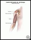 Thumbnail image of: Biceps Tendon Injury: Illustration