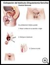 Thumbnail image of: Testicle Removal: Illustration