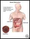 Thumbnail image of: Bowel Obstruction: Illustration