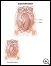 Thumbnail image of: Breech Position: Illustration
