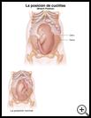 Thumbnail image of: Breech Position: Illustration