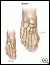 Thumbnail image of: Bunion: Illustration