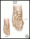 Thumbnail image of: Bunion: Illustration