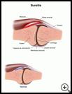 Thumbnail image of: Bursitis: Illustration