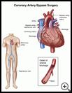 Thumbnail image of: Coronary Artery Bypass Surgery: Illustration
