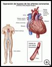 Thumbnail image of: Coronary Artery Bypass Surgery: Illustration