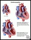 Thumbnail image of: Cardiomyopathy: Illustration