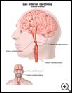 Thumbnail image of: Carotid Arteries: Illustration