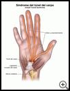 Thumbnail image of: Carpal Tunnel Syndrome: Illustration